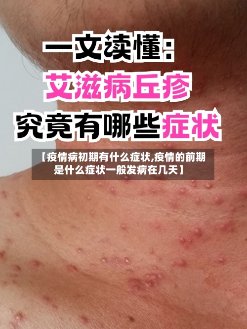 【疫情病初期有什么症状,疫情的前期是什么症状一般发病在几天】-第1张图片